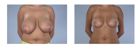 Breast Reduction - McGrath Knol